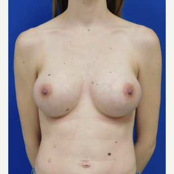 25-34 year old woman treated with Breast Augmentation after 2888693