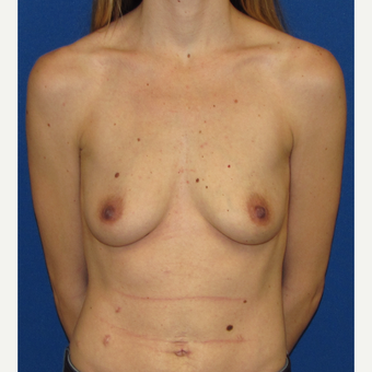 25-34 year old woman treated with Breast Augmentation before 2888693