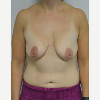 25-34 year old woman treated with Breast Lift with Implants before 3219885