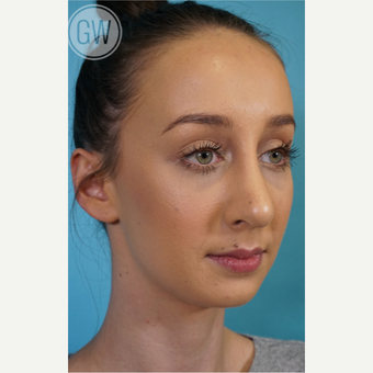 18-24 year old woman treated with Nose Surgery after 3473404