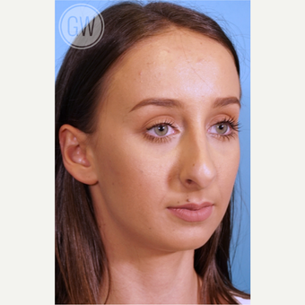 18-24 year old woman treated with Nose Surgery before 3473404