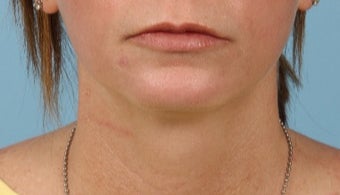 35-44 year old woman treated with Lip Implants after 3615557