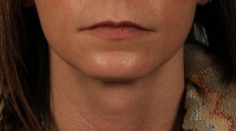 35-44 year old woman treated with Lip Implants before 3615557