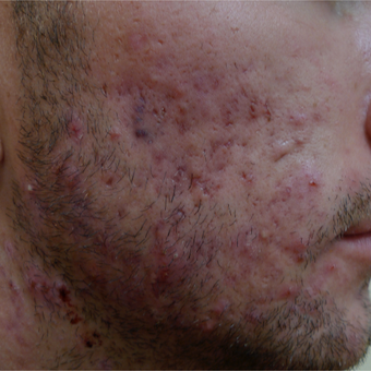 Scar prevention and acne treatments should be concurrent. before 3710528