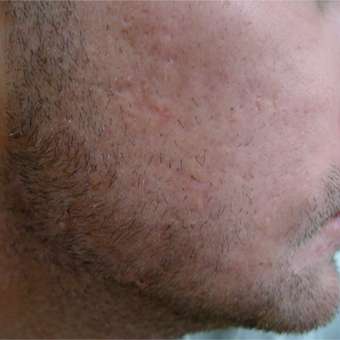 Scar prevention and acne treatments should be concurrent. after 3710528