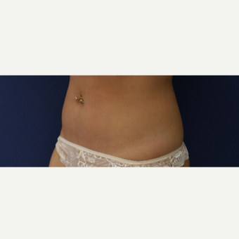 25-34 year old woman treated with CoolSculpting after 3487200