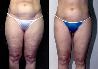 54-year-old woman treated with a Thigh Lift. before 574587