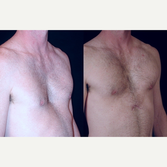 25-34 year old man treated with Pec Implants before 3659569