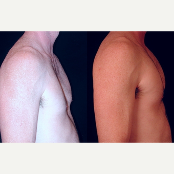 25-34 year old man treated with Pec Implants after 3659569