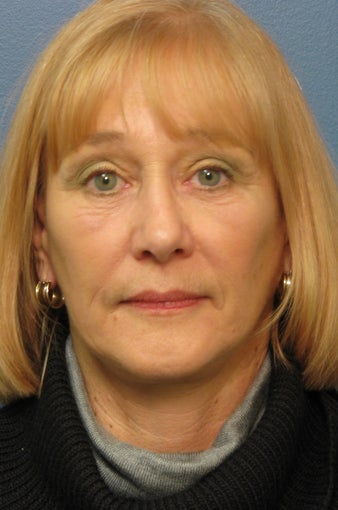 Brow Lift & Facelift after 338483