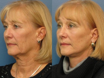 Brow Lift & Facelift 338483