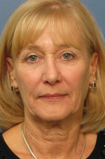 Brow Lift & Facelift before 338483