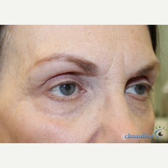65-74 year old woman treated with Mole Removal after 3139945