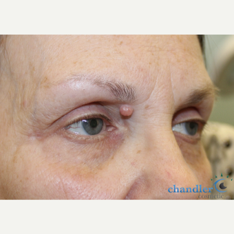 65-74 year old woman treated with Mole Removal before 3139945