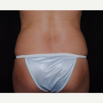 Mother of two undergoes tummy tuck and Laser Liposuction before 2967908