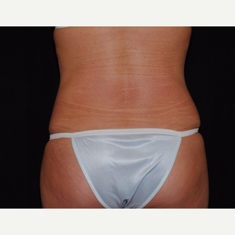 Mother of two undergoes tummy tuck and Laser Liposuction after 2967908