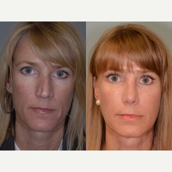 32 year old woman Revision Rhinoplasty before 2073465