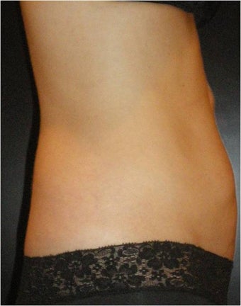 SmartLipo MPX with Pro-Sculpt before 676022