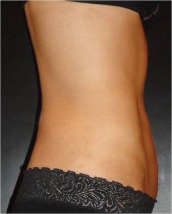 SmartLipo MPX with Pro-Sculpt after 676022