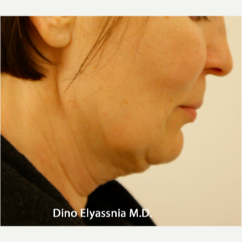 45-54 year old woman treated with Face Lift and Neck Lift before 1689021