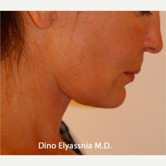 45-54 year old woman treated with Face Lift and Neck Lift after 1689021