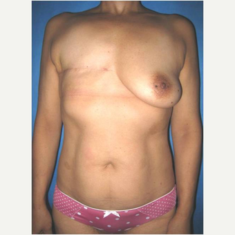 53 year old woman treated with DIEP flap Breast Reconstruction before 3724594