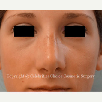 25-34 year old woman treated with Rhinoplasty after 3337792