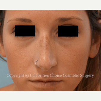 25-34 year old woman treated with Rhinoplasty before 3337792