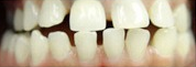 55-64 year old man treated with Invisalign before 1721458