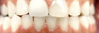 55-64 year old man treated with Invisalign after 1721458