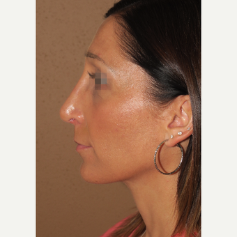 35-44 year old woman treated with Chin Surgery after 3384578