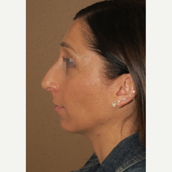 35-44 year old woman treated with Chin Surgery before 3384578