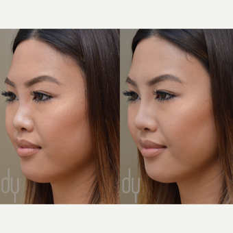 Non Surgical Rhinoplasty before 3322516