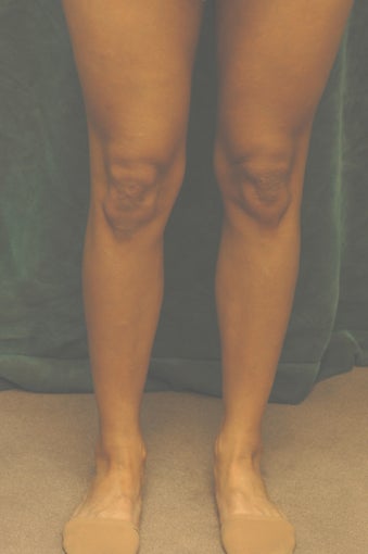 Men's Calf Augmentation 519055