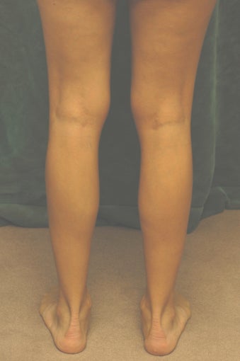 Men's Calf Augmentation before 519055
