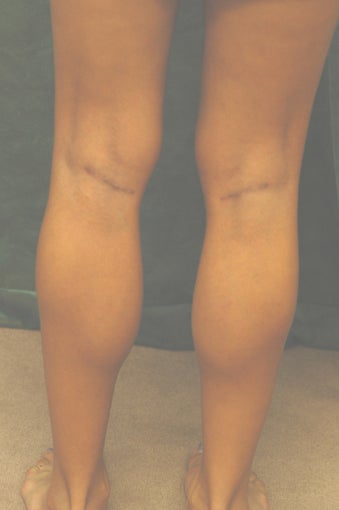 Men's Calf Augmentation after 519055