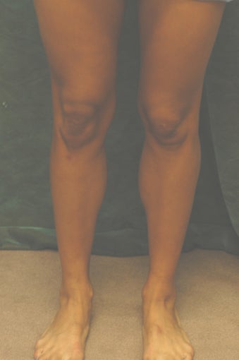 Men's Calf Augmentation 519055