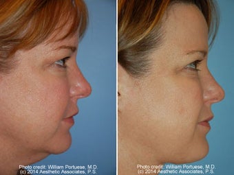 Neck Liposuction before 1389489