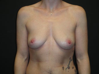 Implant-based breast reconstruction before 1266264