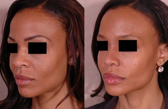 Rhinoplasty before 677279