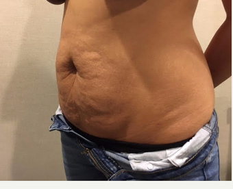 Drainless or No Drain Tummy Tuck before 3737965