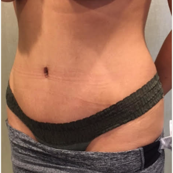 Drainless or No Drain Tummy Tuck after 3737965