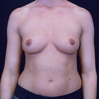 25-34 year old woman treated with Breast Augmentation before 3203130