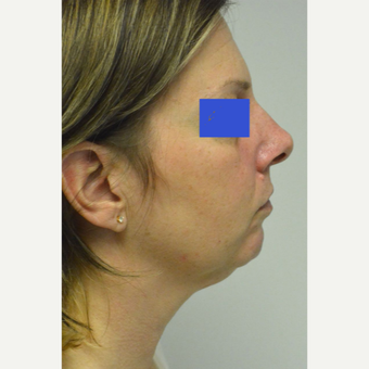 45-54 year old woman treated with Kybella before 3187156