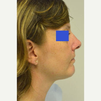 45-54 year old woman treated with Kybella after 3187156