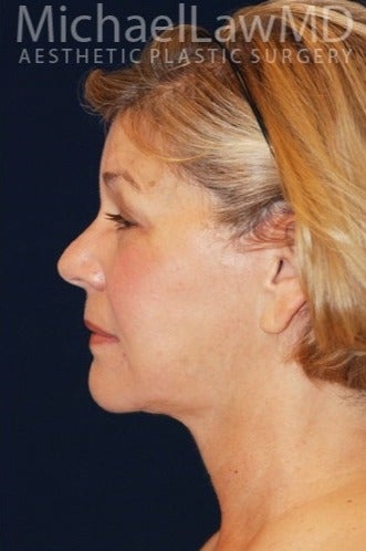 55-64 year old woman treated for SMAS Facelift after 1534796