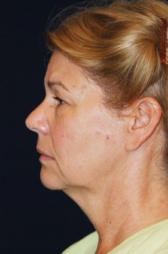 55-64 year old woman treated for SMAS Facelift before 1534796