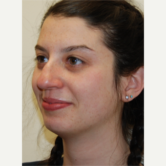 18-24 year old woman treated with Rhinoplasty before 3813733