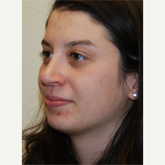 18-24 year old woman treated with Rhinoplasty after 3813733