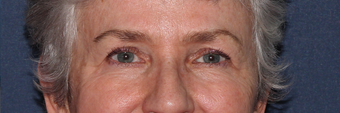 Ulthera Eyes | Before and After before 1033980